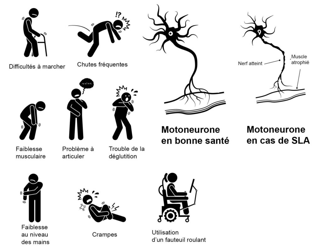 Les symptômes de la SLA